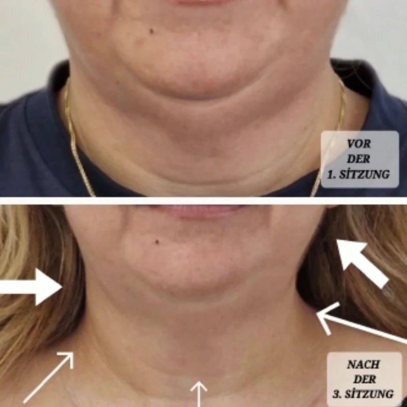 Vorher Nachher Bilder