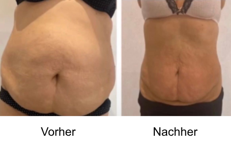 Vorher Nachher Bilder