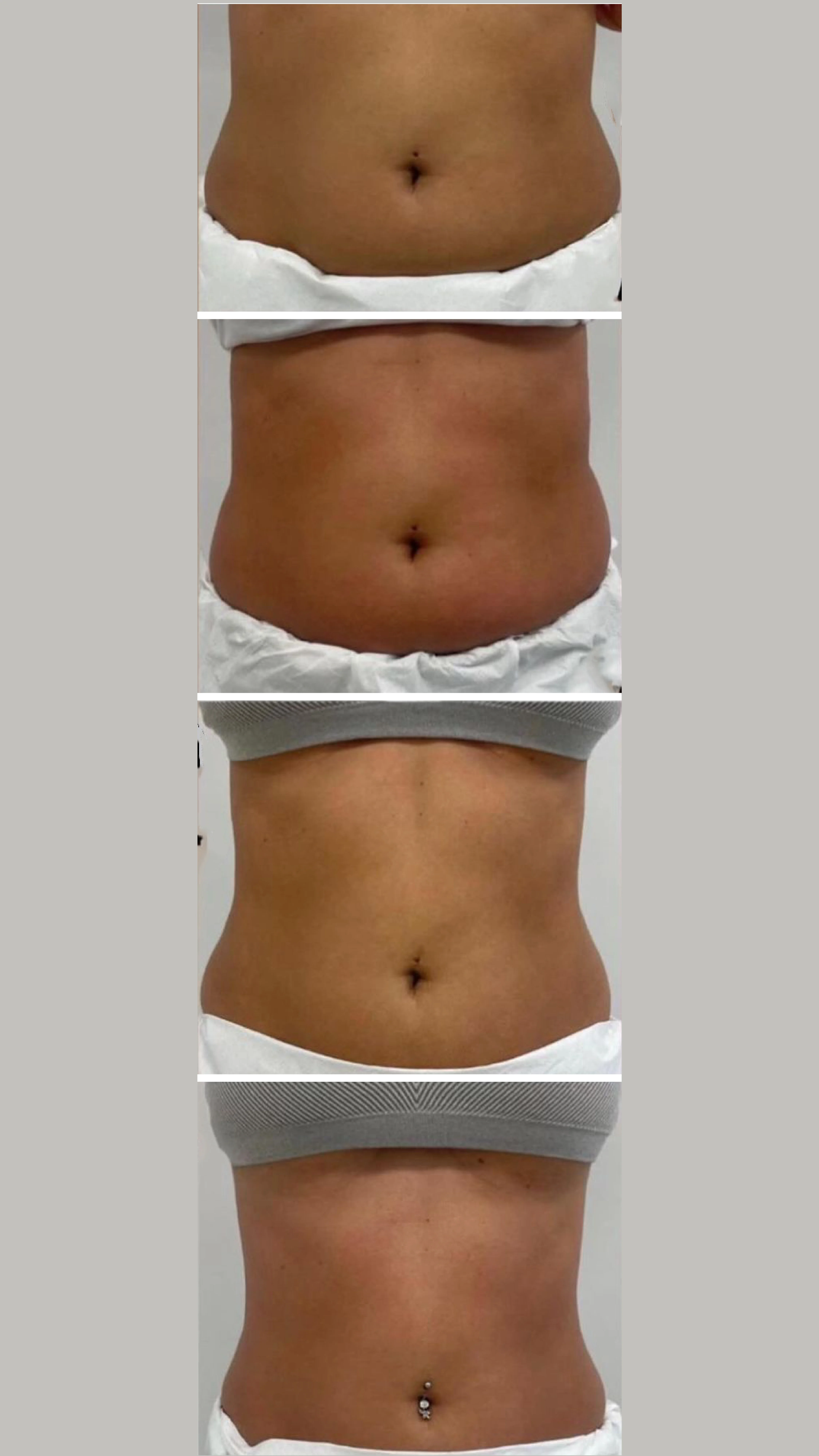 Vorher Nachher Bilder